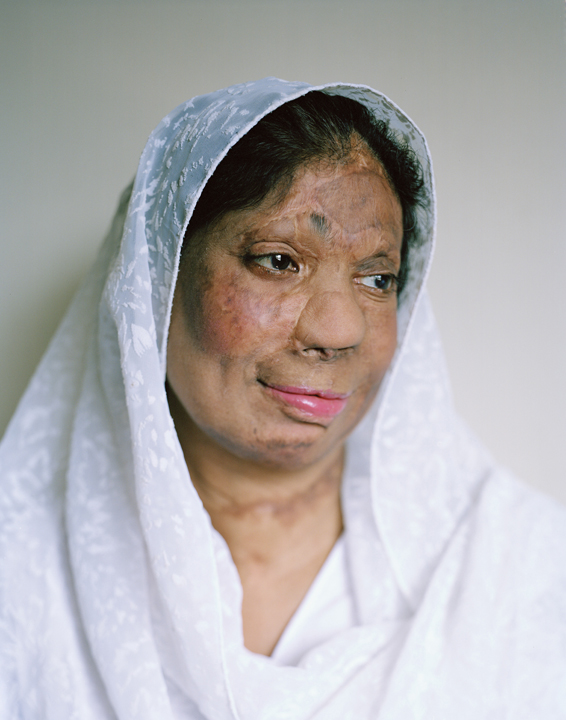 Acid attacks in Pakistan portraits of women survivors